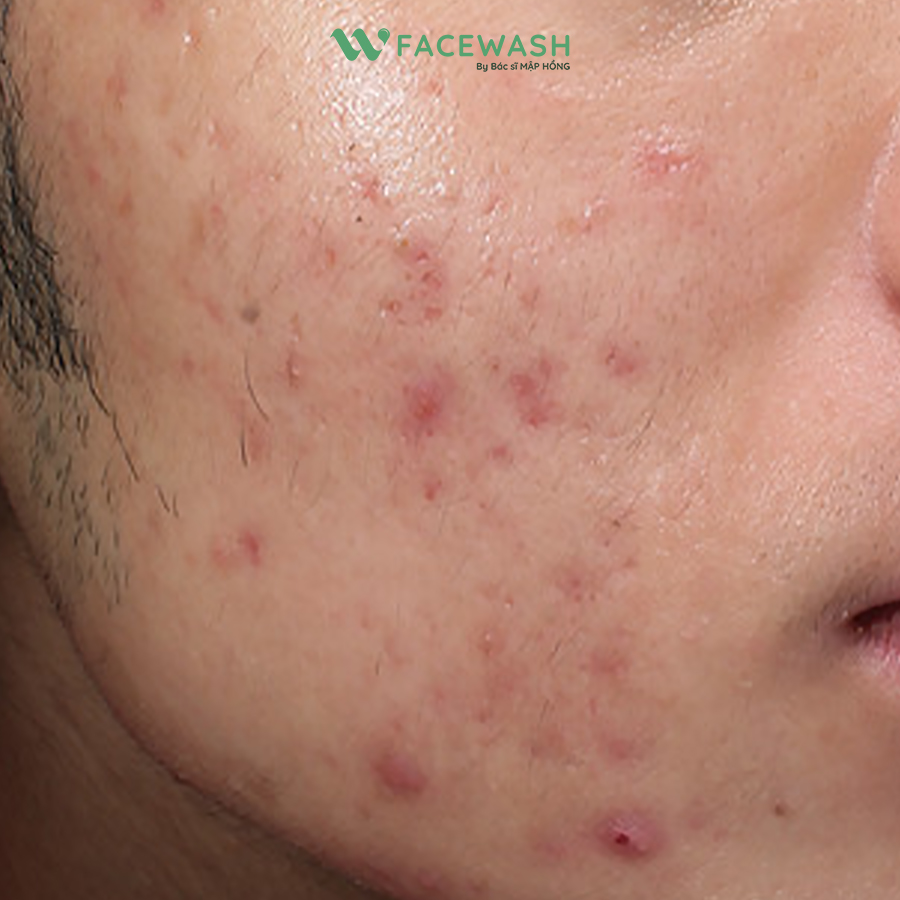 Da dầu mụn - Nỗi đau không của riêng ai