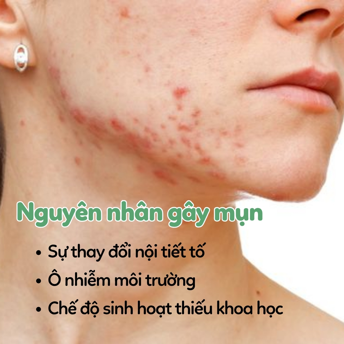 nguyen nhân gay mun 